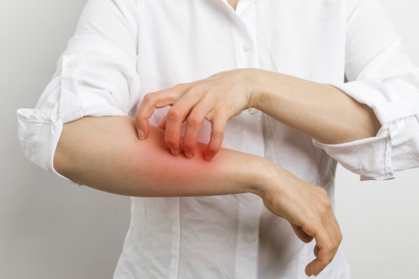 Skin Allergy Treatment in Pimpri Chinchwad, Pune by Dr. Padmawar